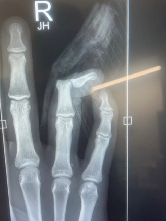 The x-ray showing Riley Reid’s badly dislocated finger suffered during the 47th Battalion carnival.