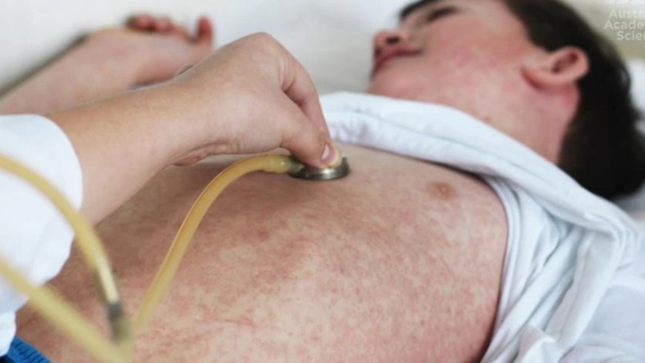 Health officials warn of measles outbreak in Northern Rivers