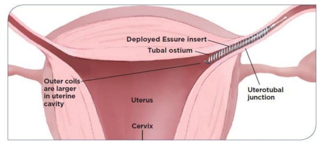 The Essure device was a metal coil inserted into the fallopian tubes to block them off and prevent pregnancy. Picture: Supplied