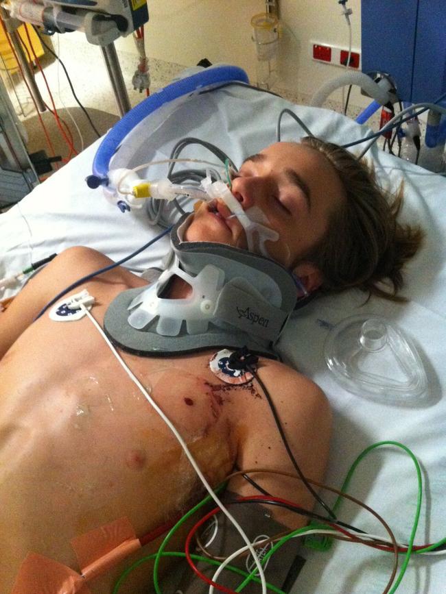 Ryan Meuleman, then aged 15, after his accident. Picture: supplied