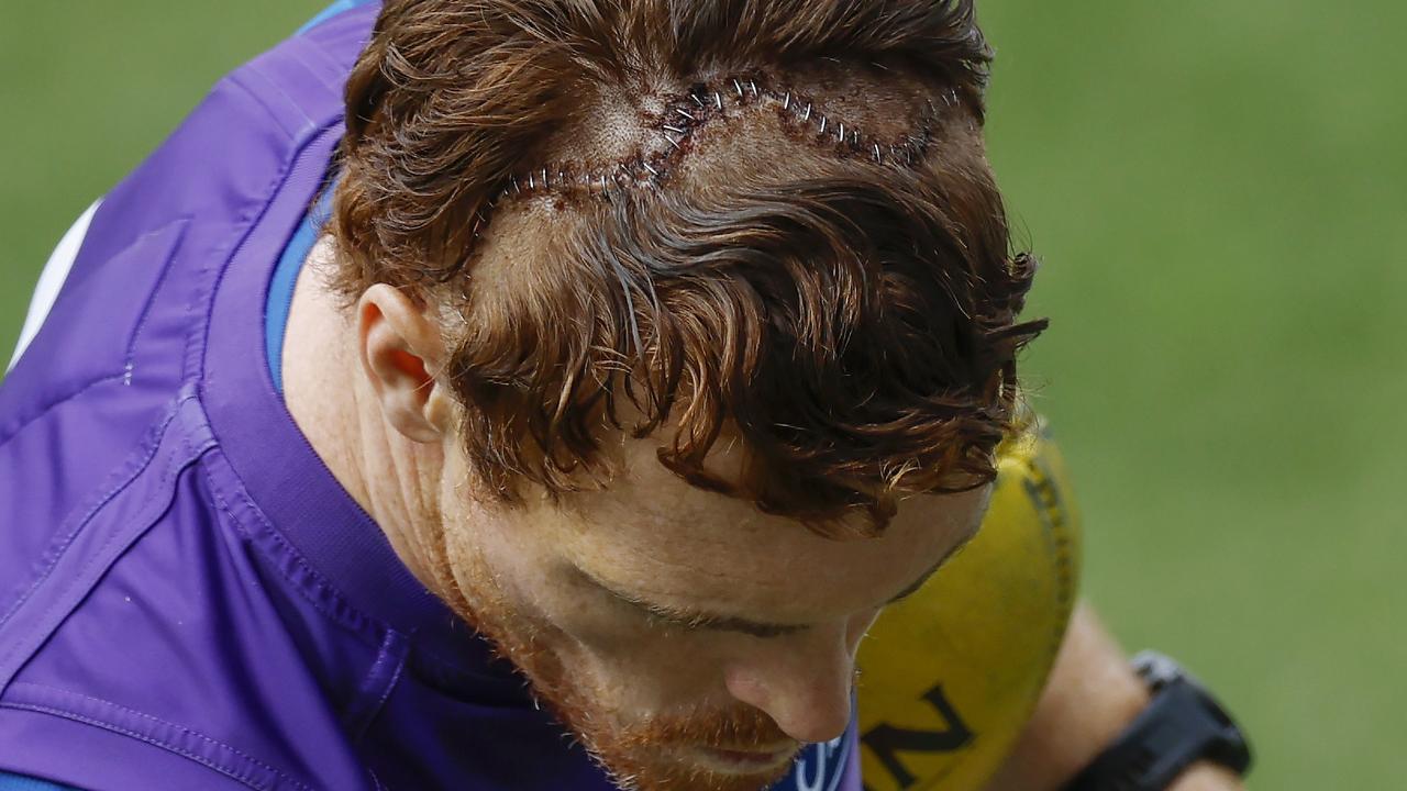 Gary Rohan’ reminder of the horror injury. Picture: Michael Klein