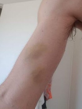 Bruising sustained by cyclist Alex Gardner on The Spit Bridge.