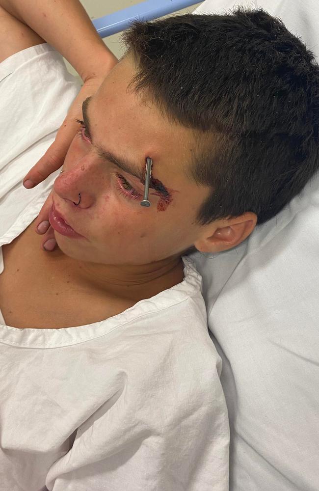 Riley Scott was struck with a nail that pierced 38mm into his head. Picture: Supplied