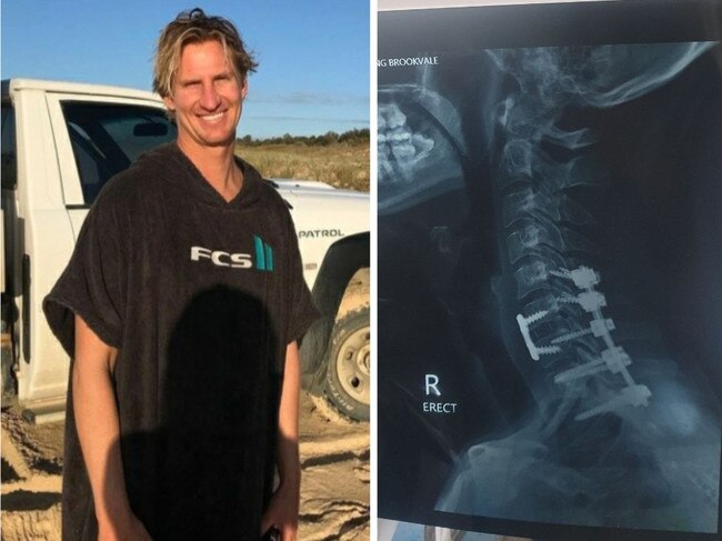 X-ray exposes tradie’s surfing nightmare