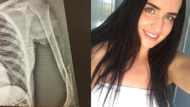 Madison Holt-Lea's scans shows her arm had snapped between her shoulder and her elbow after an alleged use of excessive force by two Yeppoon detectives.