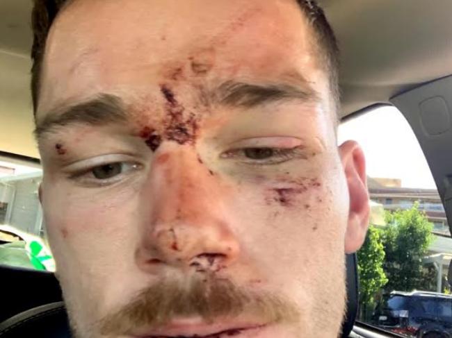 Canberra Raiders player Tom Starling after an incident with police on the Central Coast. Picture supplied