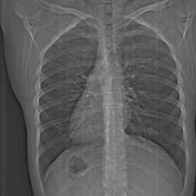 The X-ray showed mould spores growing on the woman’s lungs. Picture: Nine News/Channel 9