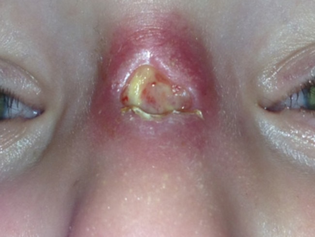 Toddler Sonny Hayes-Marshall has the flesh-eating Bairnsdale ulcer on his nose.