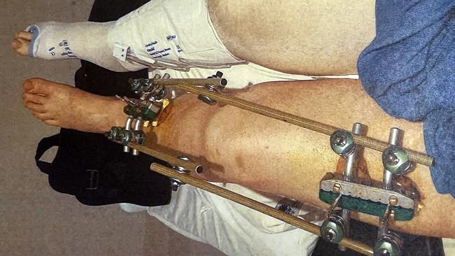 John Moran's leg in a brace as a result of the incident. Picture: Supplied