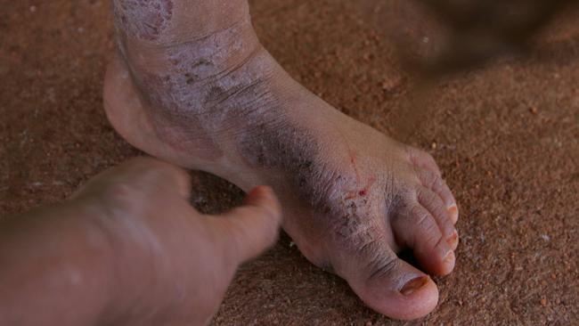 Children in indigenous communities suffer from constant infestations of scsabies from overcrowding and poor hygiene. Scabies if left unchecked can lead to renal failure from the secondary infections that get in the scratch wounds