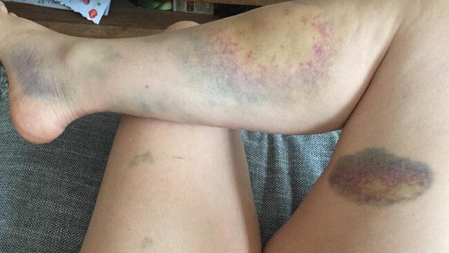 Elizabeth Ireson was left with serious bruises