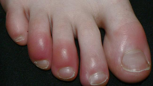 A person with chilblained toes. Picture: Wikipedia