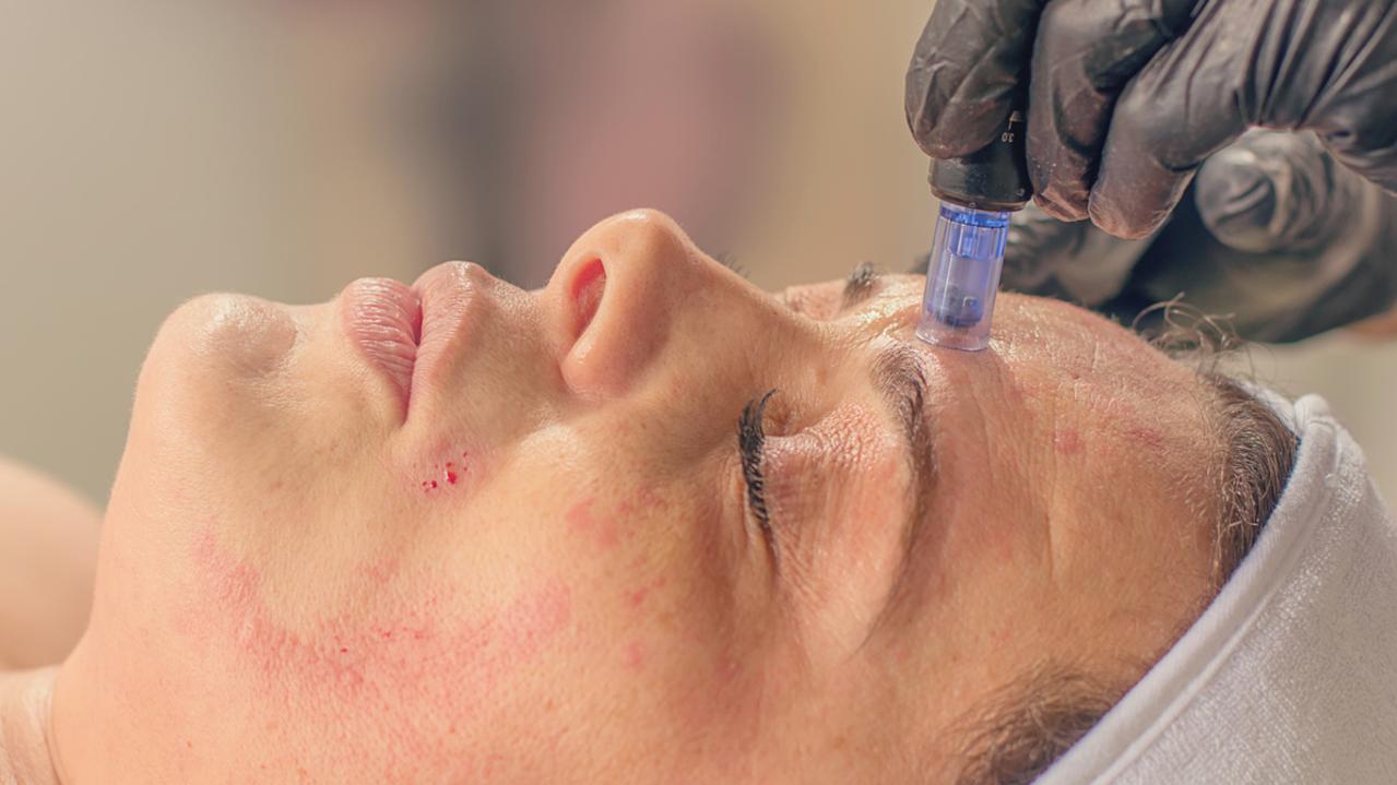 Skin needling is now a popular treatment in Australia’s cosmetic industry. Picture: iStock