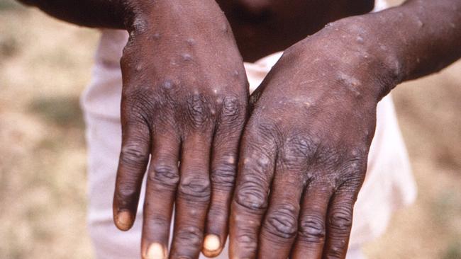 The lesions on a person’s hands as a result of Monkeypox. Picture: AFP / Brian W.J. Mahy, BSc, MA, PhD, ScD, DSc / Centers for Disease Control and Prevention