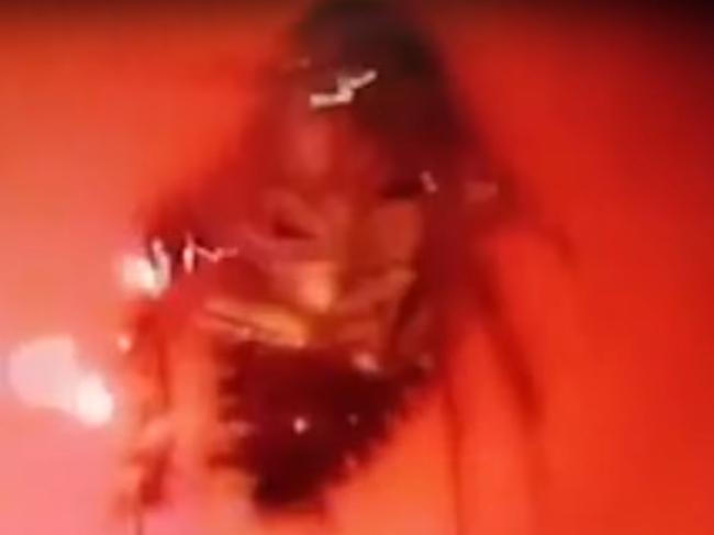 Doctors discovered a live cockroach inside an Indian woman's skull