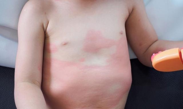 Hives And Rashes On Kids Dr Sam Hay Explains What To Do When Your Child Breaks Out Kidspot