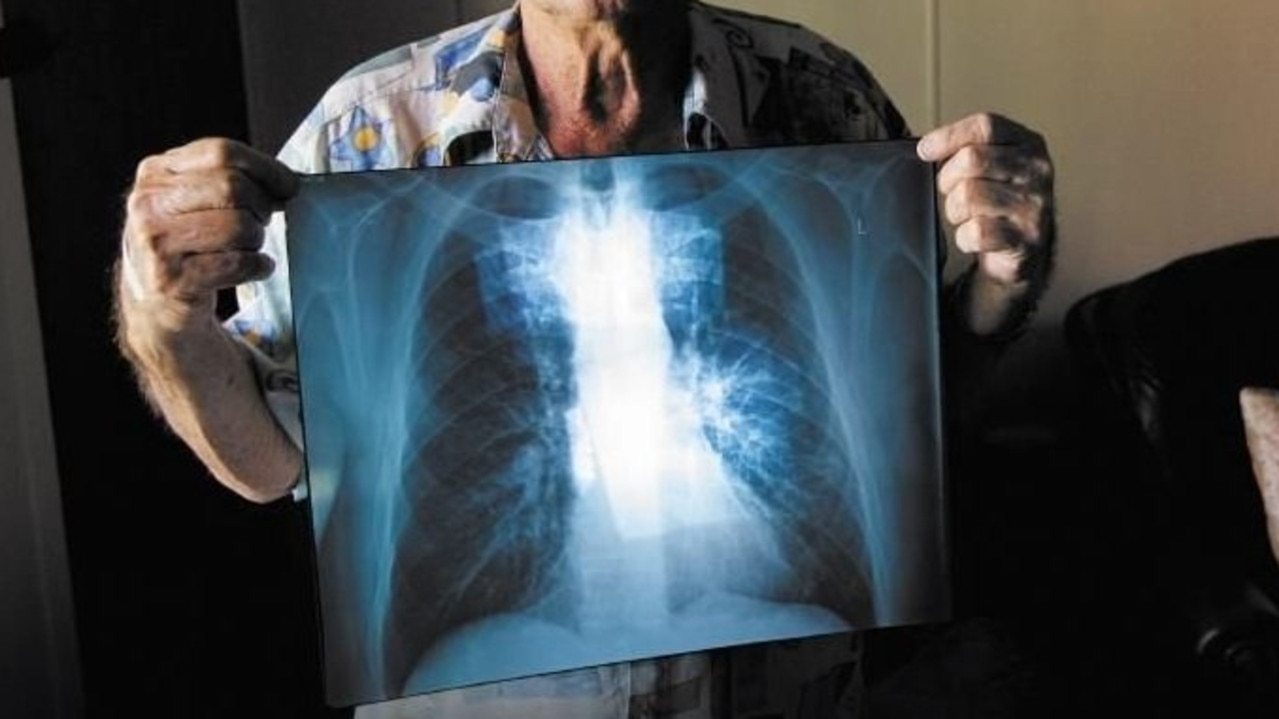 BLACK LUNG: Percy Verrall was diagnosed with black lung disease in 2015. He was the first Australian diagnosed with the disease in 30 years.