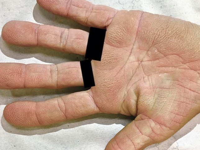 The 73-year-old woman went to the doctors after she broke out in these strange marks on her hands - which was diagnosed as tripe palmsCredit: The New England Journal of Medicine