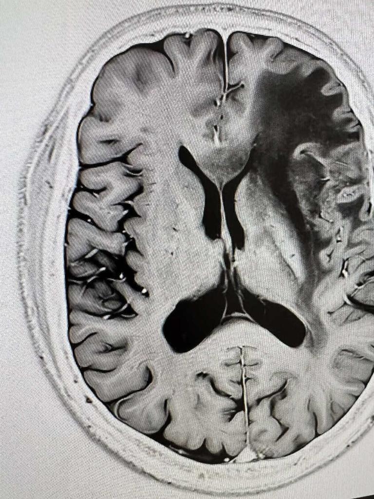 A recent MRI scan of Professor Scolyer’s brain. Picture: Instagram.