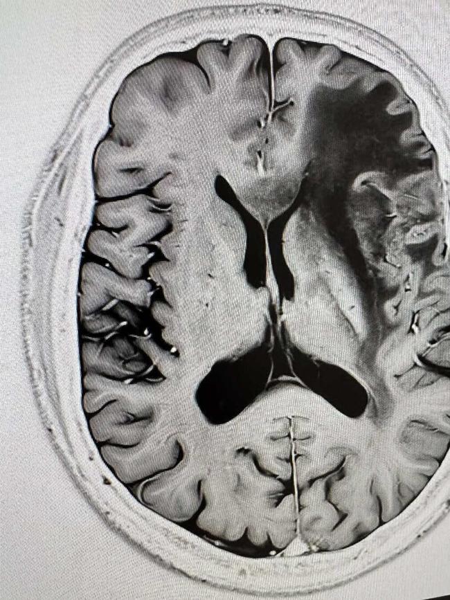 A recent MRI scan of Professor Scolyer’s brain. Picture: Instagram.