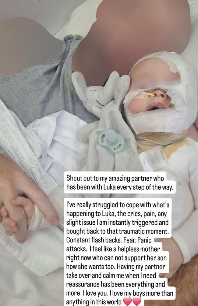 The mother of a baby Luka,, burned by coffee in a shocking random attack in a Brisbane park has shared an incredible update as her son faces his third surgery. Picture: Supplied