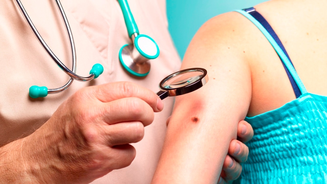 Concerns of skin cancer checks being delayed