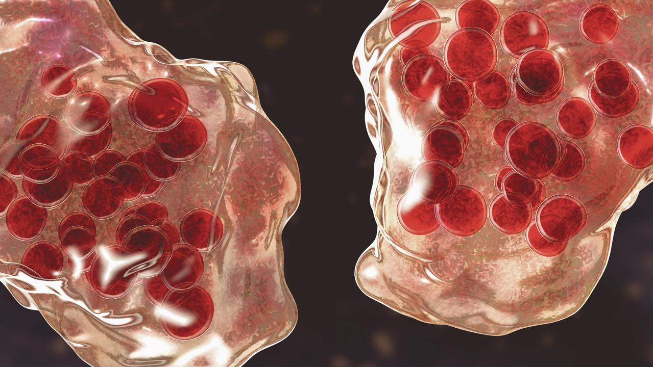 An illustration of measles virus infection showing giant multinucleated cells seen during microscopy of biopsy specimens. A measles case has been detected in an adult returning from Southeast Asia. Picture: Supplied