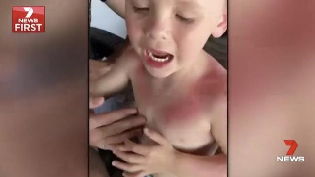 Little boy suffers severe burns from sunscreen