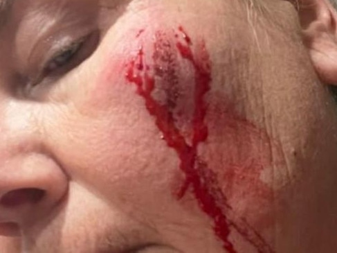 Ungarra woman hit by hailstone the size of a golf ball, as storms wreak havoc in South Australia. Catherine Gail from Ungarra, near Tumby Bay, was hit by a hailstone the size of a golf ball when she rushed outside to move her car on Thursday, 15 August 2024. Picture: 7 NEWS