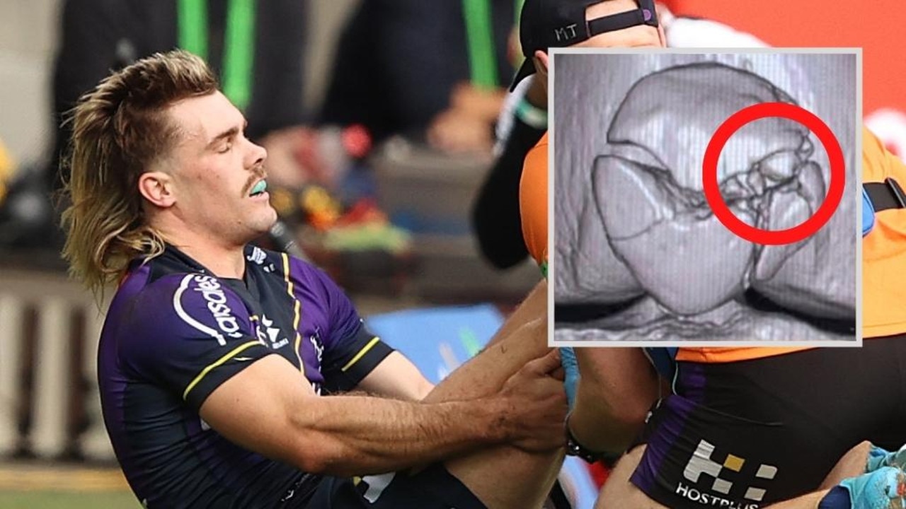 X-ray images of Ryan Papenhuyzen’s shattered patellar show exactly why the Melbourne Storm fullback’s knee cap fracture is “one of the most brutal NRL injuries seen in years”.