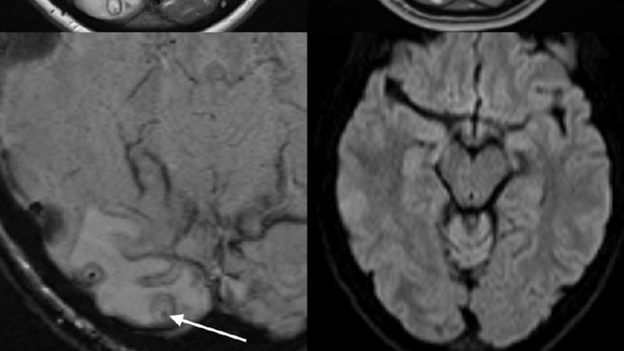 MRI of cyst found in the brain of woman later diagnosed with neurocysticercosis. Source: The American Society of Tropical Medicine and Hygiene