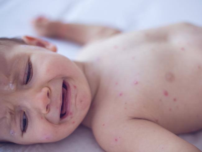 Are anti-vaxxers driving ‘worrying’ rise of measles in SA?
