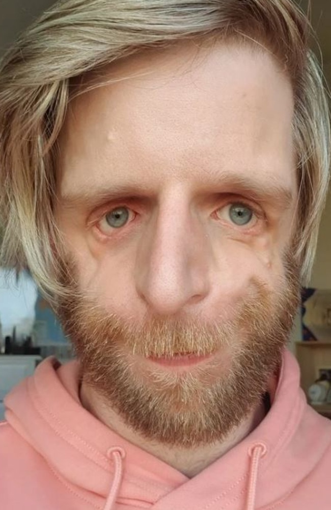 His parents abandoned him at birth, with a cruel hospital document he discovered at 24 revealing they were “horrified” by his appearance. Picture: Instagram