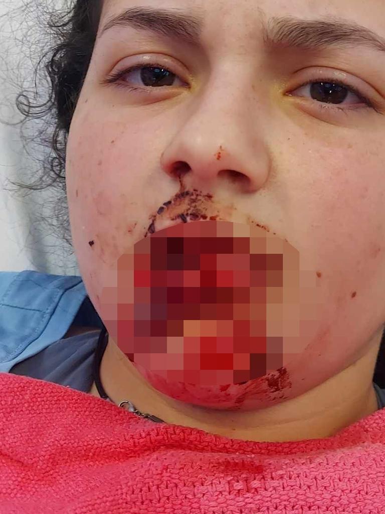 Niki Chrysanthopoulos was eating a snack when the family’s American bull-terrier, Ollie, snapped and attacked her. Picture: Supplied