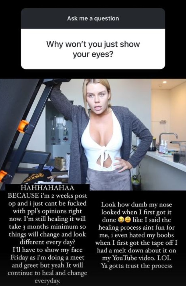 Wheatley explained why she’s yet to show off the results of the procedure during a Q&A on Instagram. Picture: Instagram