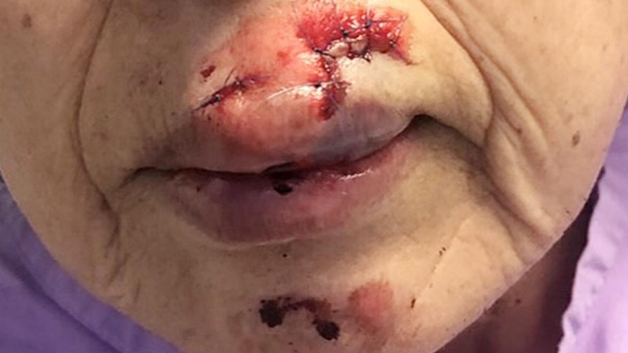 Facial injuries allegedly inflicted by a brick