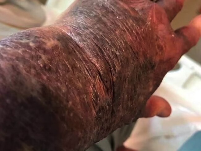 Aussie gran suffers horrific bruising after receiving the COVID jab