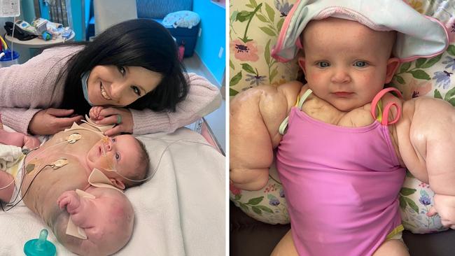 Little Armani Milby was born with a rare condition that gave her an enlarged upper body and arms. Picture: Caters News