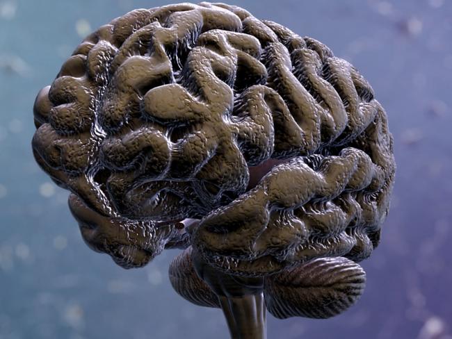 Image showing brain atrophy in Alzheimer's disease brain. Image: Supplied.