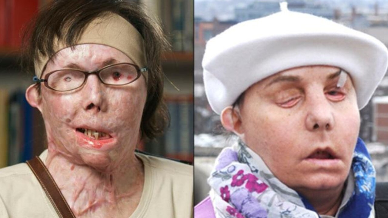 The nurse was left disfigured. Picture: NBC