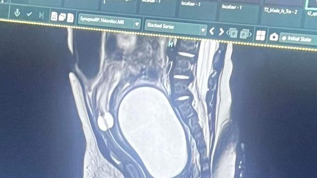 An MRI scan of Rylen's cyst.