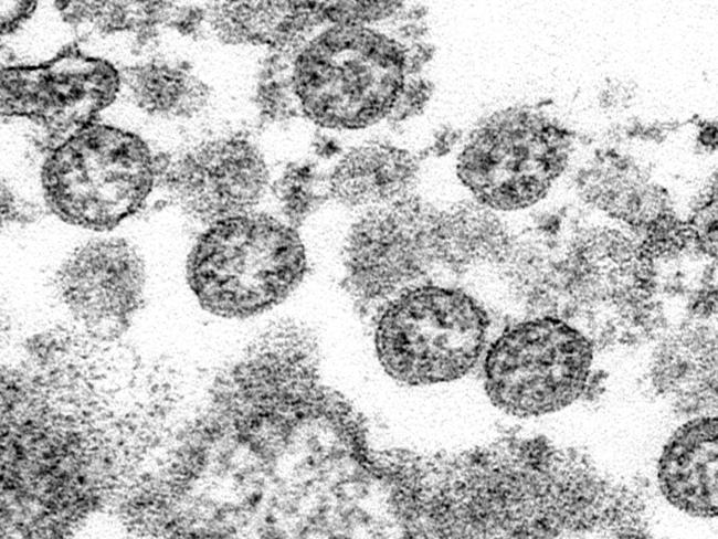 This 2020 electron microscope made available by the U.S. Centers for Disease Control and Prevention image shows the spherical coronavirus particles from the first U.S. case of COVID-19. On Monday, May 4, 2020, New York City health authorities issued an alert to doctors about severe inflammatory condition possibly linked with COVID-19 has been found in a cluster of U.S. children in New York City after first being reported in Europe. On Wednesday, New York said 64 potential cases had been reported to the state. Fever, abdominal pain and skin rashes are common symptoms of the unnamed condition, which has features similar to Kawasaki disease and toxic shock syndrome. (C.S. Goldsmith, A. Tamin/CDC via AP)