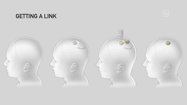 This video grab made from the online Neuralink livestream shows a drawing of the different steps of the implantation of a Neuralink device. Picture: Neuralink.