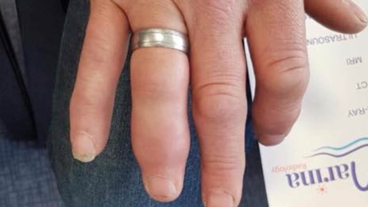 Rings Stuck On Fingers