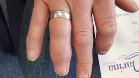 Knox SES had to help a man after he broke his finger and couldn’t get the ring off.