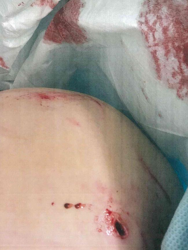 Photos showing a woman's injuries sustained from a bite from Sarge the staffy. Source: Moreton Bay Regional Council