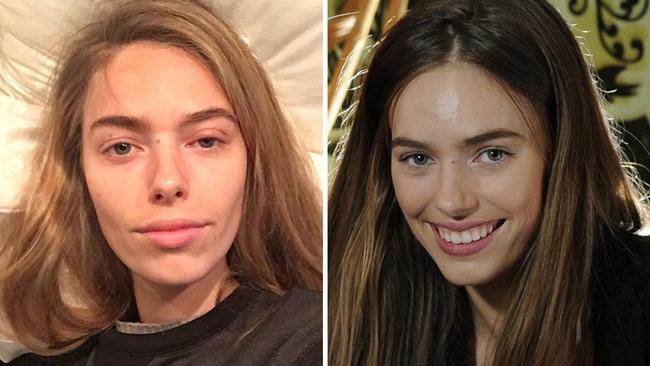 Anthea Page has called for improved hygiene standards after she contracted Golden Staph backstage at Sydney Fashion Weekend.
