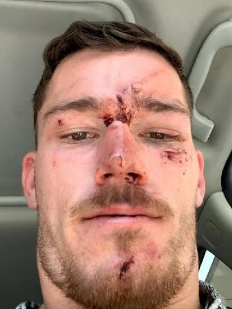 Canberra Raiders player Tom Starling after the incident with police on the Central Coast. Picture: Supplied