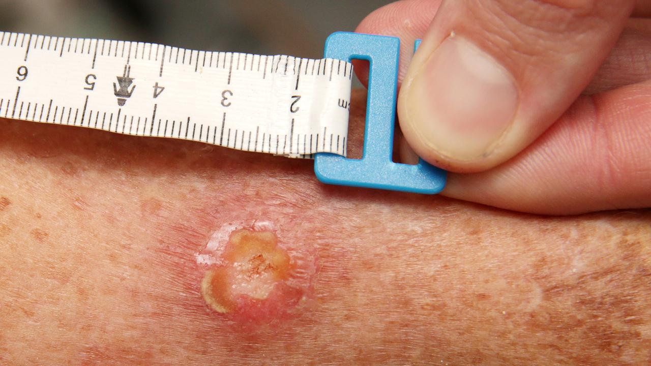 A treatment for Buruli ulcer, aka Bairnsdale ulcer, has been added to the PBS. Picture: Norm Oorloff