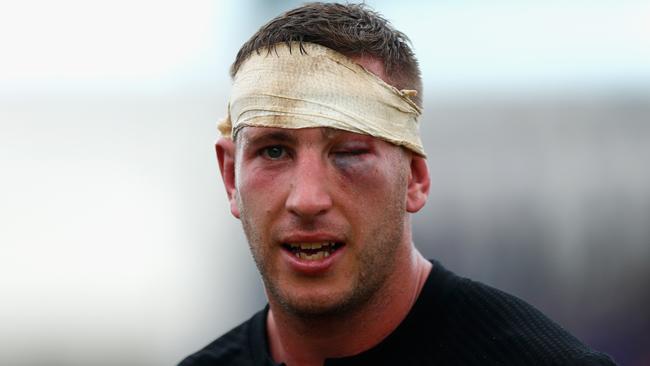 Luke Romano of the All Blacks shows the scars of the Samoa match.